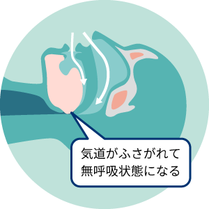のどの奥で気道がふさがれて無呼吸状態になる