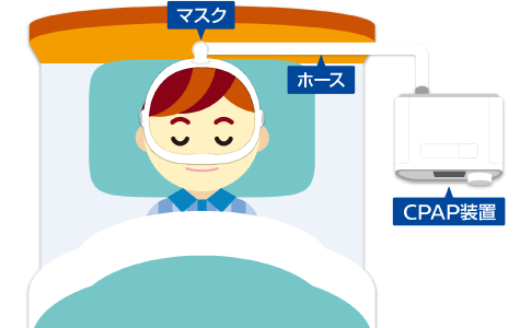 CPAP（シーパップ）装置による治療